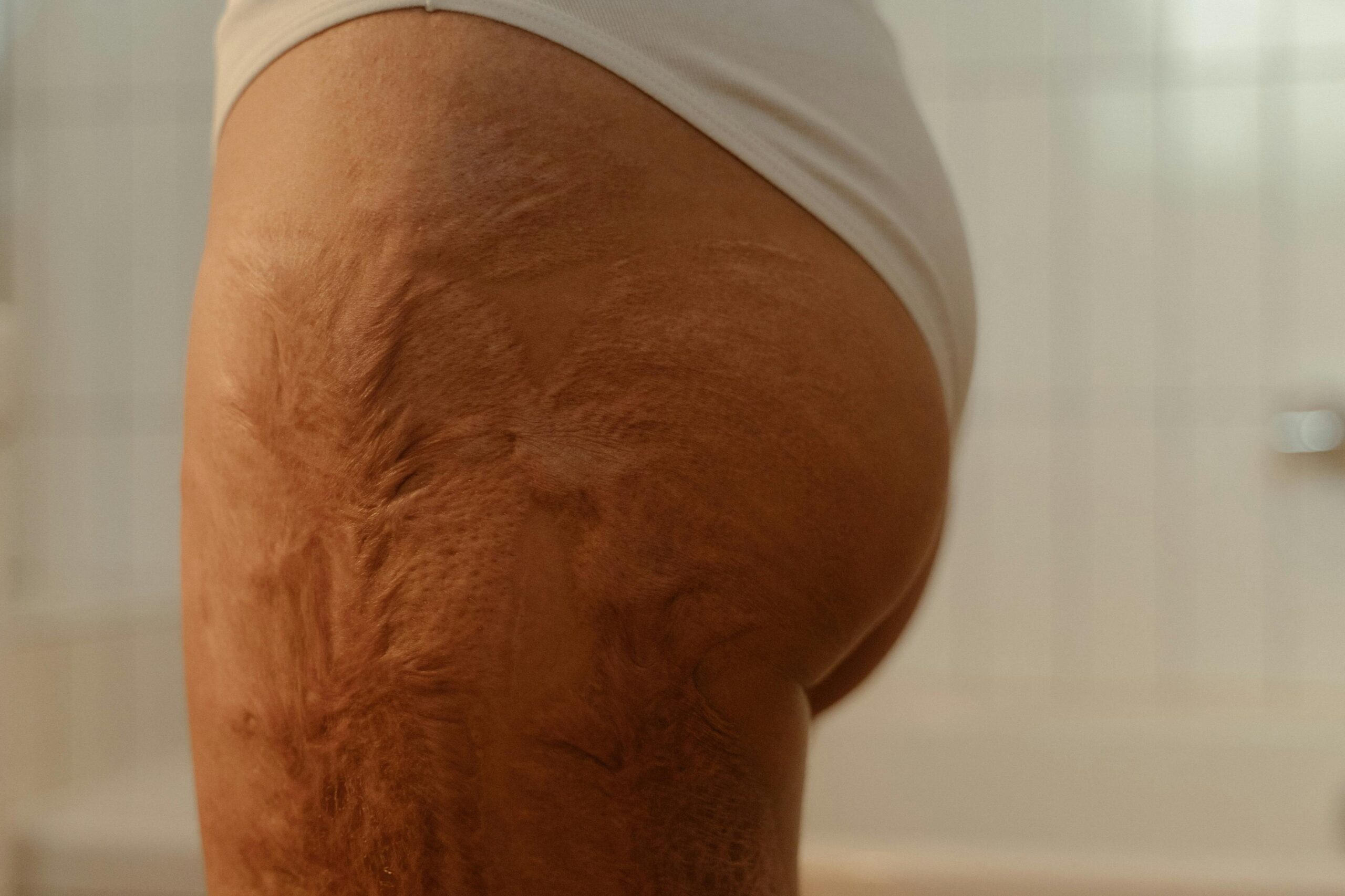 Detailed close-up of scarred skin on a thigh, highlighting texture and healing process.